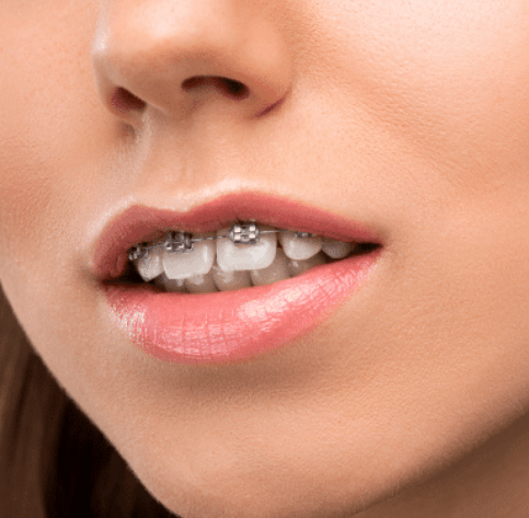 Why Orthodontists Are Experts In Correcting Bite Issues