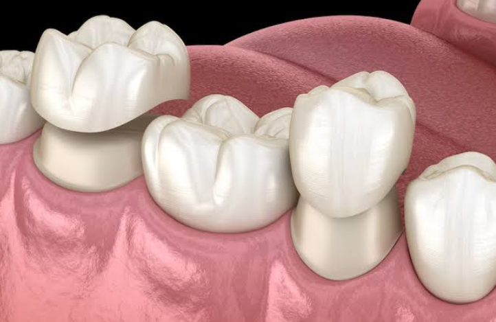 6 Signs An Implant Crown May Need Cosmetic Refinement